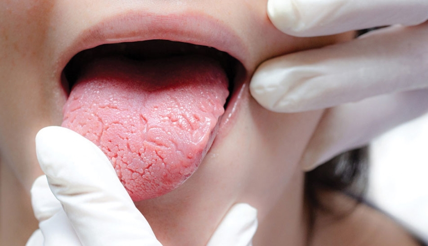 Mundtrockenheit; schon erkennt?